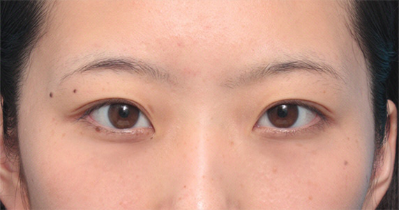 目の下の脂肪取り,目の下のクマ治療,目の下の脂肪を除去して、クマを目立たなくした症例写真,After（1ヶ月後）,ba_shibo10_a01.jpg