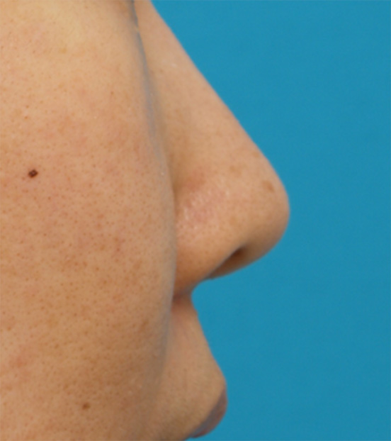 症例写真,耳介軟骨移植（鼻先を出す）,Before,ba_jikai11_b.jpg
