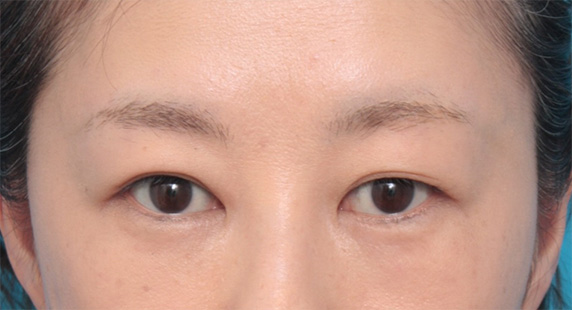 目の下の脂肪を取り、埋もれていた涙袋が浮き出てきた症例写真の術前術後画像,After（6ヶ月後）,ba_shibo12_a01.jpg