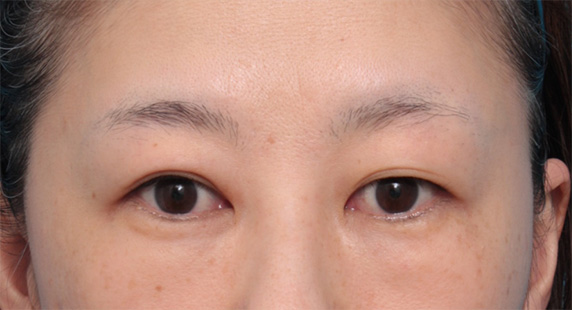 目の下の脂肪を取り、埋もれていた涙袋が浮き出てきた症例写真の術前術後画像,Before,ba_shibo12_b.jpg