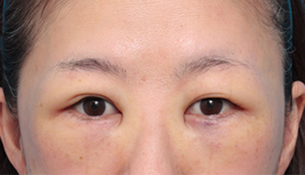症例写真,目の下の脂肪を取り、埋もれていた涙袋が浮き出てきた症例写真の術前術後画像,手術直後,mainpic_shibo06b.jpg