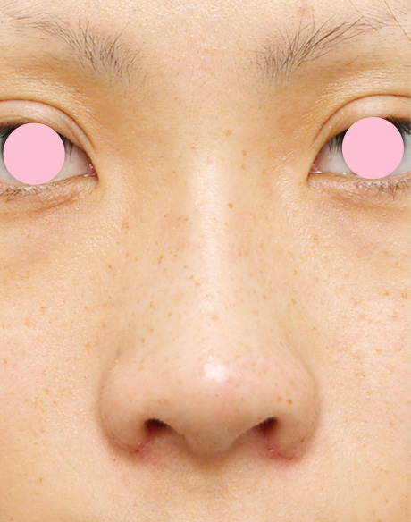 耳介軟骨移植（鼻先を出す）の症例 鼻先が少し上を向いている20代女性,Before,ba_jikai17_b.jpg