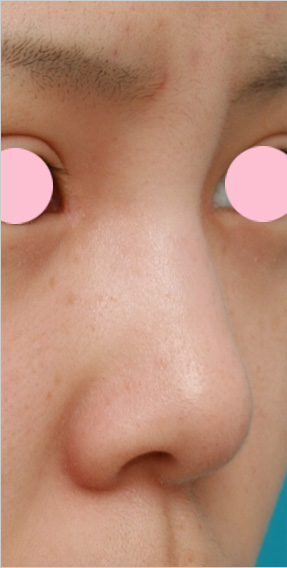 耳介軟骨移植（鼻先を出す）の症例 鼻先が低いのが気になっていた10代女性,Before,ba_jikai09_b.jpg
