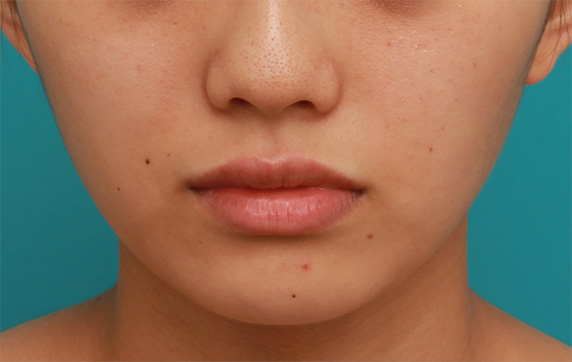 症例写真,薄い上唇にヒアルロン酸を注射して厚くし、下唇とのバランスを整えた症例写真の術前術後画像,After（3ヶ月後）,ba_atsuku30_b.jpg