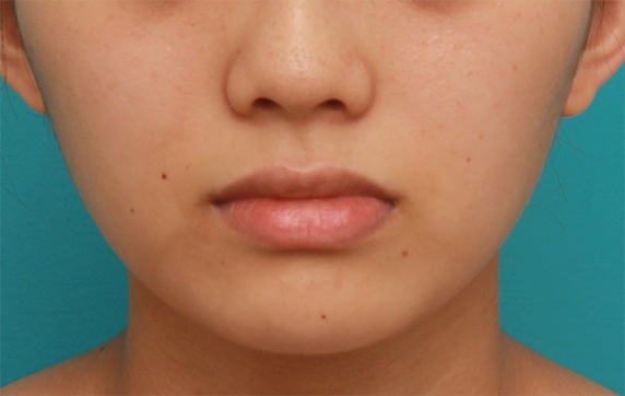 症例写真,薄い上唇にヒアルロン酸を注射して厚くし、下唇とのバランスを整えた症例写真の術前術後画像,Before,ba_atsuku30_b.jpg