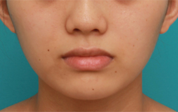 症例写真,薄い上唇にヒアルロン酸を注射して厚くし、下唇とのバランスを整えた症例写真の術前術後画像,注射前,mainpic_atsuku03a.jpg