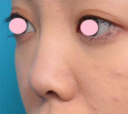 症例写真,鼻先に耳介軟骨移植をして鼻先を斜め下方向に出した症例写真,Before,ba_jikai21_b.jpg