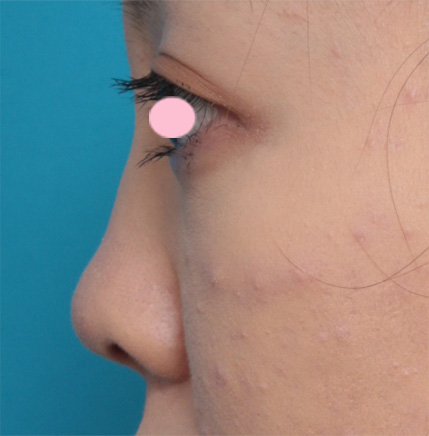 耳介軟骨移植（鼻先を出す）,鼻先に耳介軟骨移植をして鼻先を斜め下方向に出した症例写真,Before,ba_jikai22_b.jpg