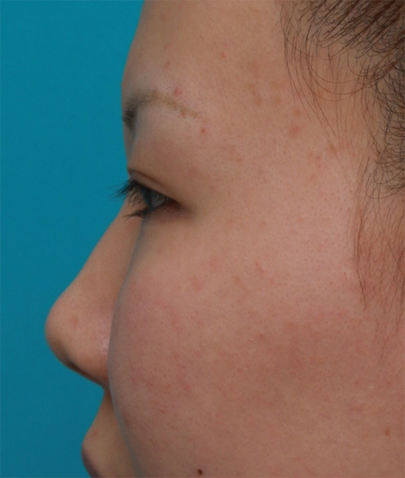 症例写真,耳介軟骨移植+鼻翼（小鼻）縮小+長期持続型ヒアルロン酸注射の症例写真,Before,ba_jikai25_b.jpg