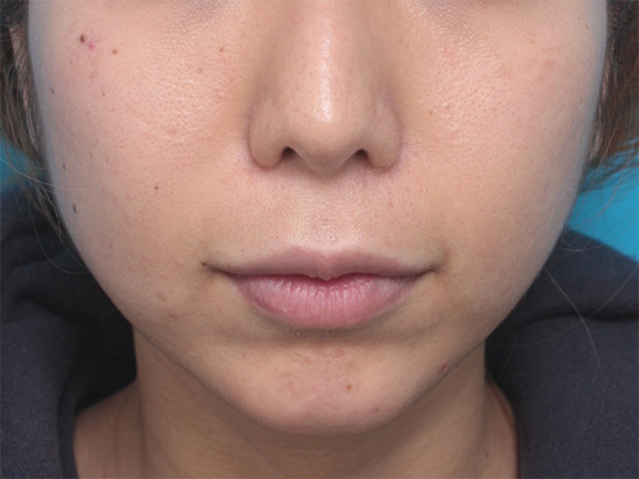 症例写真,患者様の希望で、下唇にヒアルロン酸を多めに注入して、癒し系の唇にした症例写真,After,ba_atsuku25_b.jpg