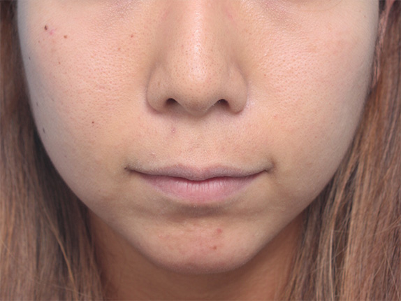 症例写真,患者様の希望で、下唇にヒアルロン酸を多めに注入して、癒し系の唇にした症例写真,Before,ba_atsuku25_b.jpg