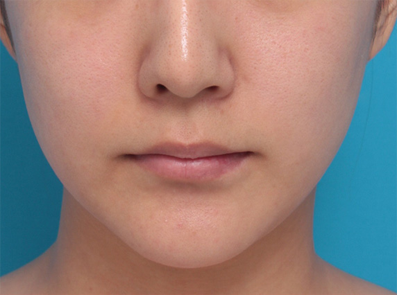 症例写真,薄い唇にヒアルロン酸注射を1本（1cc）して、ぷっくりセクシーな唇にした症例写真,Before,ba_atsuku24_b.jpg