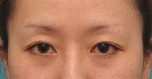 症例写真,片目のみ目の下の切らない脂肪取り（ふくらみ・クマ・たるみ取り）をして左右対称に近づけた症例写真の術前術後画像,1ヶ月後,mainpic_shibo07d.jpg