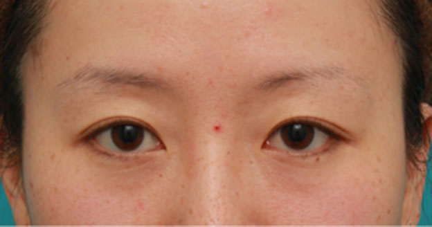 症例写真,片目のみ目の下の切らない脂肪取り（ふくらみ・クマ・たるみ取り）をして左右対称に近づけた症例写真の術前術後画像,4ヶ月後,mainpic_shibo07e.jpg