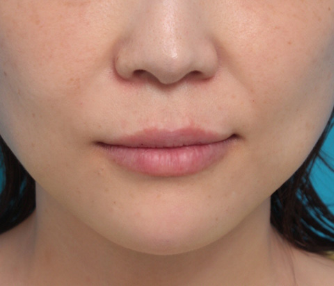 症例写真,幸薄い下唇にヒアルロン酸注射して、ぷっくり可愛い唇にした症例写真,注射直後,ba_atsuku22b.jpg