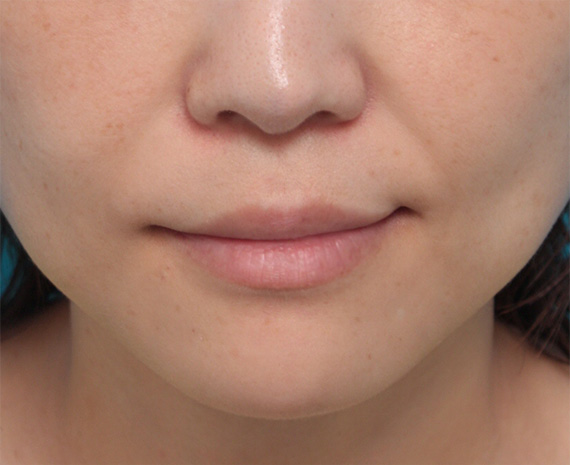 症例写真,幸薄い下唇にヒアルロン酸注射して、ぷっくり可愛い唇にした症例写真,After（1週間後）,ba_atsuku23_b.jpg