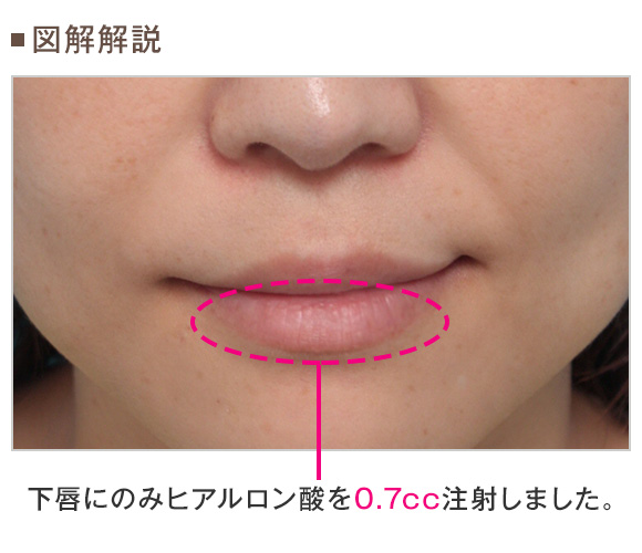 唇を厚くするのは ヒアルロン酸と脂肪注入のどちらが良いのか Dr 高須幹弥の美容整形講座 美容整形の高須クリニック
