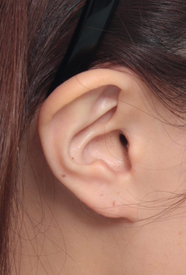 耳介軟骨移植（鼻先を出す）,耳介軟骨移植で鼻先を斜めした方向に出した症例写真,3ヶ月後,mainpic_jikai05f.jpg
