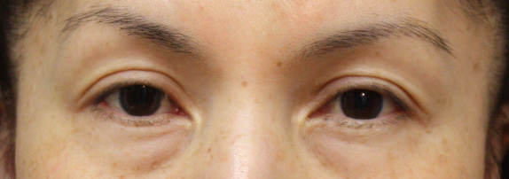 くぼみ目修正（ヒアルロン酸注射）の症例写真 痩せているために目がくぼみやすかった女性,After,ba_kubomi05_a01.jpg
