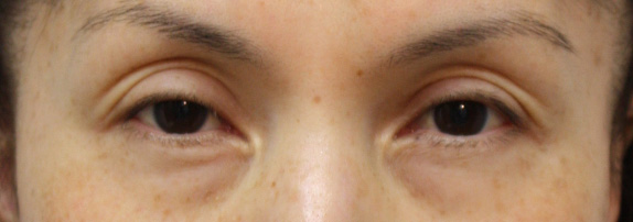 くぼみ目修正（ヒアルロン酸注射）の症例写真 痩せているために目がくぼみやすかった女性,Before,ba_kubomi05_b.jpg