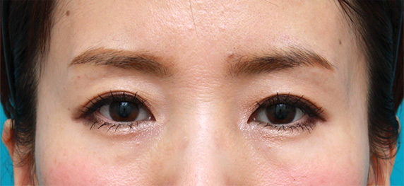 注射式シワ取り 長期持続型ヒアルロン酸注入,目の上の窪みにヒアルロン酸を注射し、二重のラインをはっきりさせた症例写真,After（メイクあり）<br/>
（1週間後）,