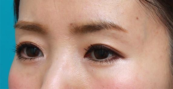 注射式シワ取り 長期持続型ヒアルロン酸注入,目の上の窪みにヒアルロン酸を注射し、二重のラインをはっきりさせた症例写真,After（メイクあり）<br/>
（1週間後）,