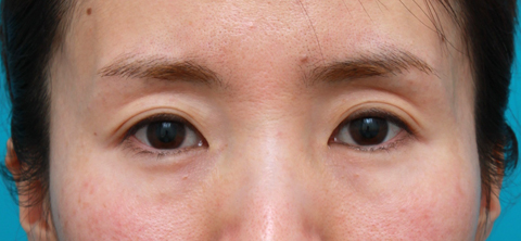 注射式シワ取り 長期持続型ヒアルロン酸注入,目の上の窪みにヒアルロン酸を注射し、二重のラインをはっきりさせた症例写真,注射前,mainpic_kubomi01a.jpg