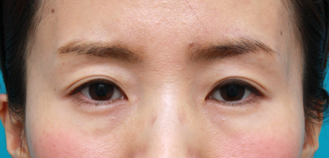 注射式シワ取り 長期持続型ヒアルロン酸注入,目の上の窪みにヒアルロン酸を注射し、二重のラインをはっきりさせた症例写真,1週間後,メイクなし,mainpic_kubomi01c.jpg