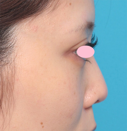 症例写真,鼻先と鼻柱基部(鼻柱の付け根)に耳介軟骨移植をした症例写真,Before,ba_jikai35_b.jpg