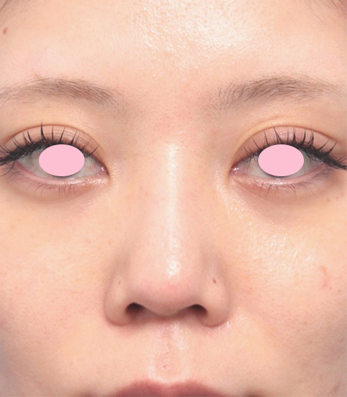 症例写真,鼻先と鼻柱基部(鼻柱の付け根)に耳介軟骨移植をした症例写真,手術前,mainpic_jikai06a.jpg