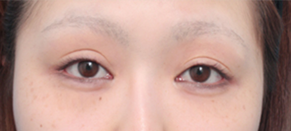 症例写真,涙袋ヒアルロン酸症例写真,After(メイクなし),ba_namida06_b.jpg