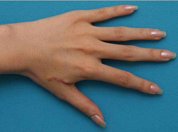 症例写真,手の甲の根性焼きを切除縫縮して1本の傷にした症例写真,1週間後,mainpic_keisei11c.jpg