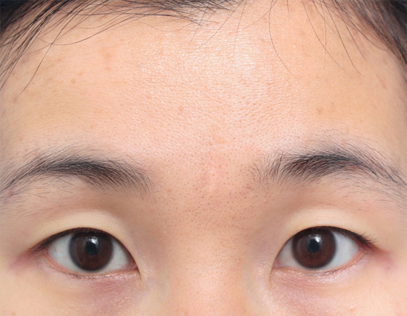 症例写真,眉間の傷跡を切除縫縮手術して目立たなくした症例写真,After（6ヶ月後）,ba_keisei26_b.jpg