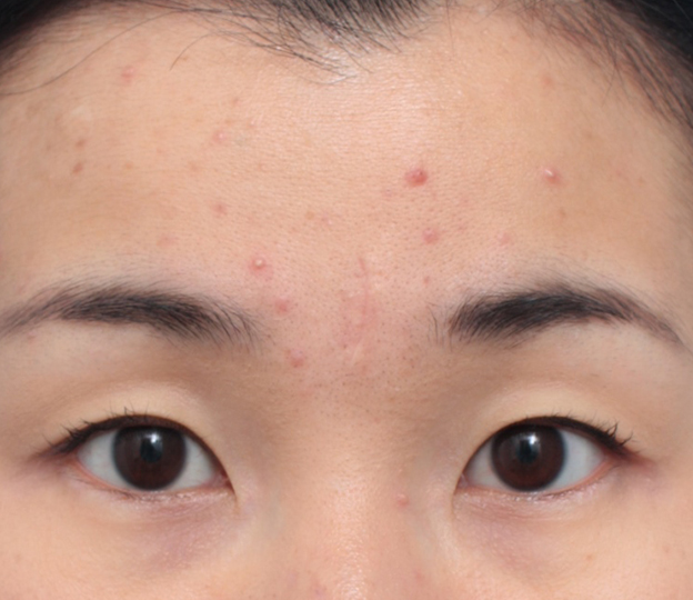 症例写真,眉間の傷跡を切除縫縮手術して目立たなくした症例写真,1ヶ月後,mainpic_keisei13d.jpg