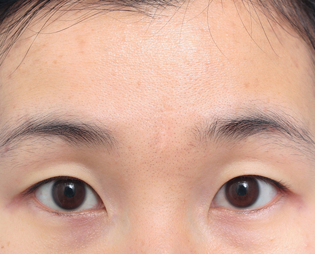 症例写真,眉間の傷跡を切除縫縮手術して目立たなくした症例写真,6ヶ月後,mainpic_keisei13e.jpg