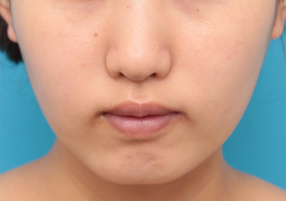 症例写真,ボツリヌストキシン注射で下がっている口角を自然に上げた20代女性の症例写真,After（1週間後）,ba_lipsup_botox03_b.jpg