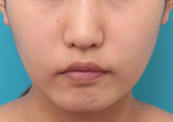ボツリヌストキシン注射で下がっている口角を自然に上げた20代女性の症例写真,Before,ba_lipsup_botox03_b.jpg