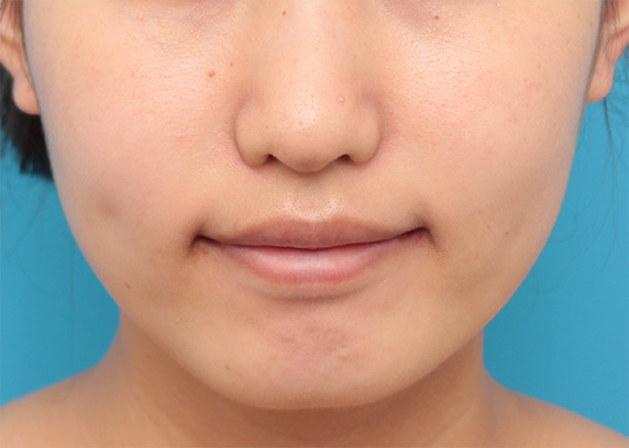 症例写真,ボツリヌストキシン注射で下がっている口角を自然に上げた20代女性の症例写真,After（1週間後）,ba_lipsup_botox04_b.jpg