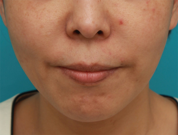 ボツリヌストキシン注射で下がった口角を上げた40代女性の症例写真の術前術後画像,After（1週間後）,ba_lipsup_botox02_a01.jpg