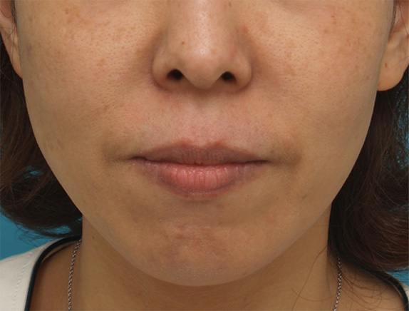 症例写真,ボツリヌストキシン注射で下がった口角を上げた40代女性の症例写真の術前術後画像,Before,ba_lipsup_botox02_b.jpg