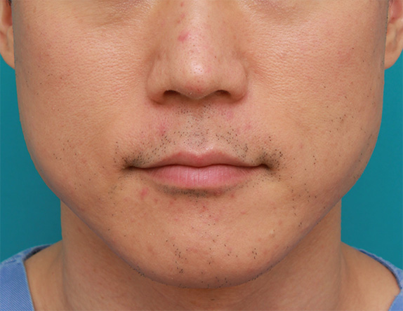 症例写真,ボツリヌストキシン注射で下がった口角を上げた症例写真,Before,ba_lipsup_botox01_b.jpg