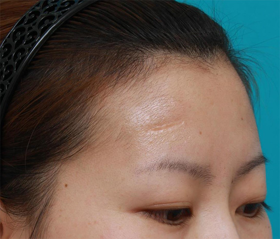 症例写真,額の傷跡を切除縫縮で修正手術した症例写真,Before,ba_keisei28_b.jpg
