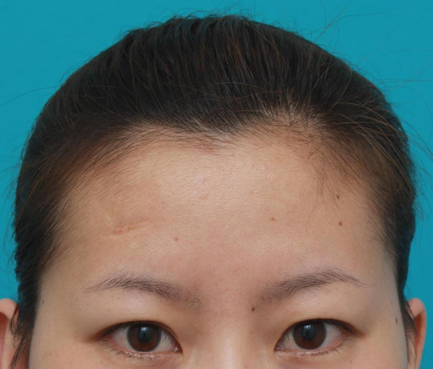 症例写真,額の傷跡を切除縫縮で修正手術した症例写真,手術前,mainpic_keisei14a.jpg