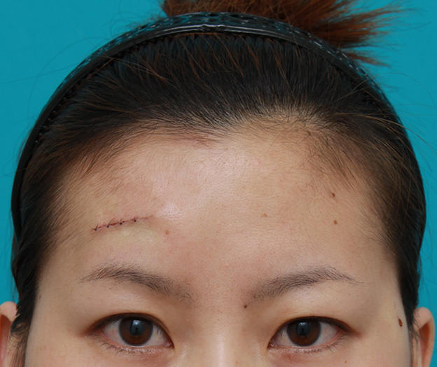 症例写真,額の傷跡を切除縫縮で修正手術した症例写真,手術直後,mainpic_keisei14b.jpg