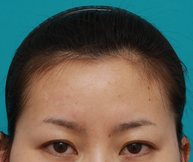 症例写真,額の傷跡を切除縫縮で修正手術した症例写真,3ヶ月後,mainpic_keisei14e.jpg