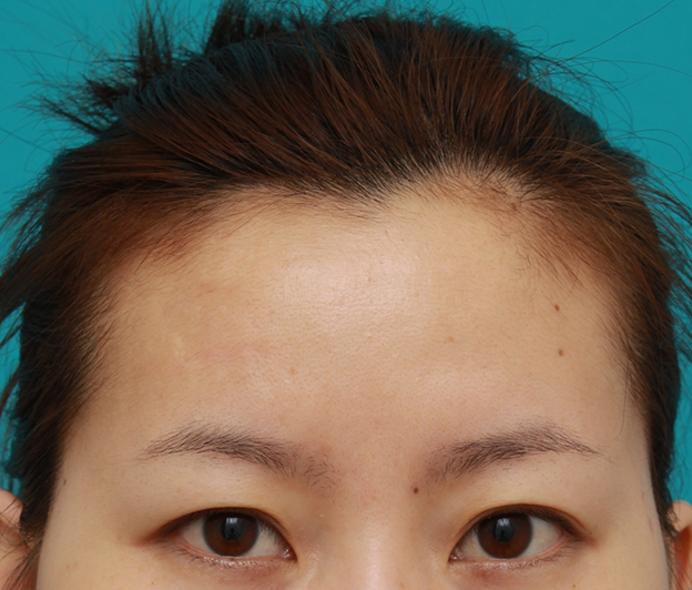 症例写真,額の傷跡を切除縫縮で修正手術した症例写真,6ヶ月後,mainpic_keisei14f.jpg