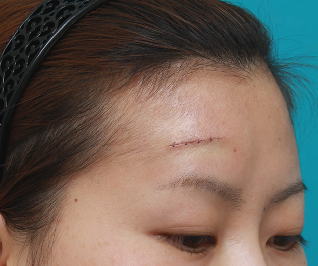 症例写真,額の傷跡を切除縫縮で修正手術した症例写真,手術直後,mainpic_keisei14h.jpg