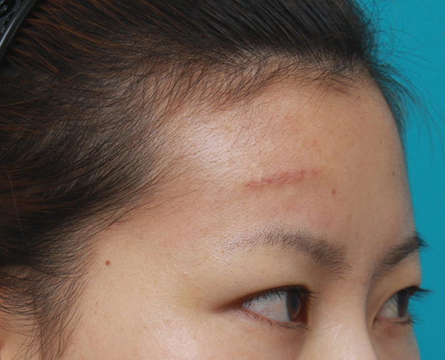 症例写真,額の傷跡を切除縫縮で修正手術した症例写真,1週間後,mainpic_keisei14i.jpg