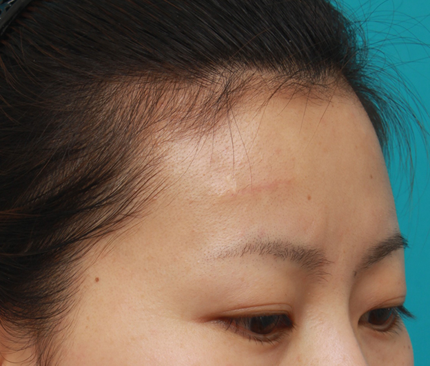 症例写真,額の傷跡を切除縫縮で修正手術した症例写真,1ヶ月後,mainpic_keisei14j.jpg