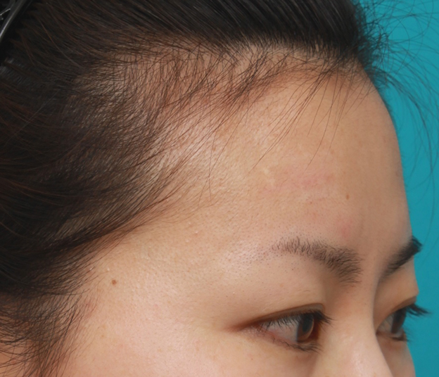 症例写真,額の傷跡を切除縫縮で修正手術した症例写真,3ヶ月後,mainpic_keisei14k.jpg